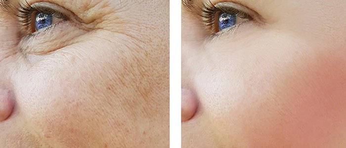 face-skin-rejuvenation