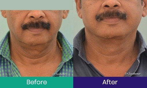 Instant-Face-Lift-male
