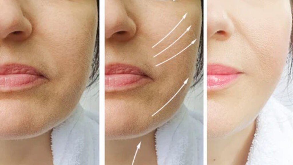 wrinkle-reduction-female
